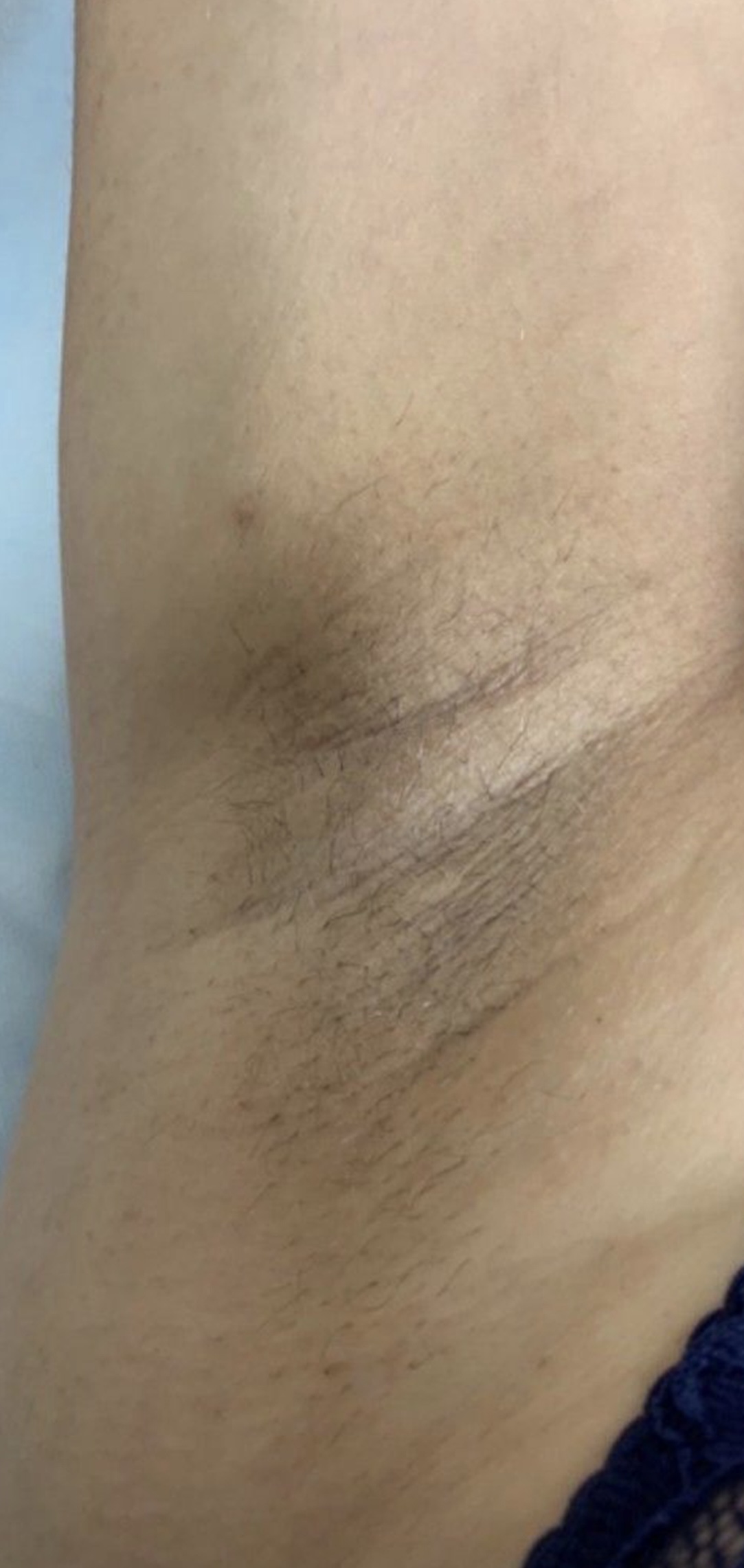 T-Element Neo treatment result 3
