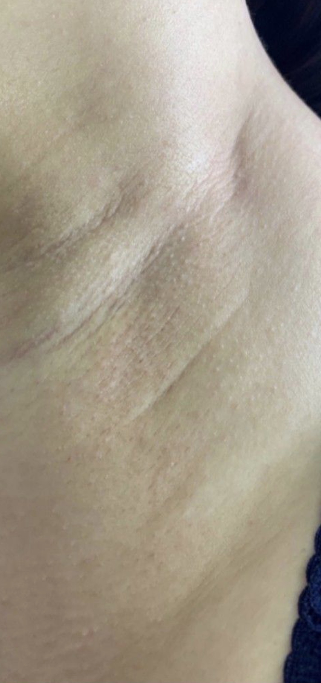 T-Element Neo treatment result 4