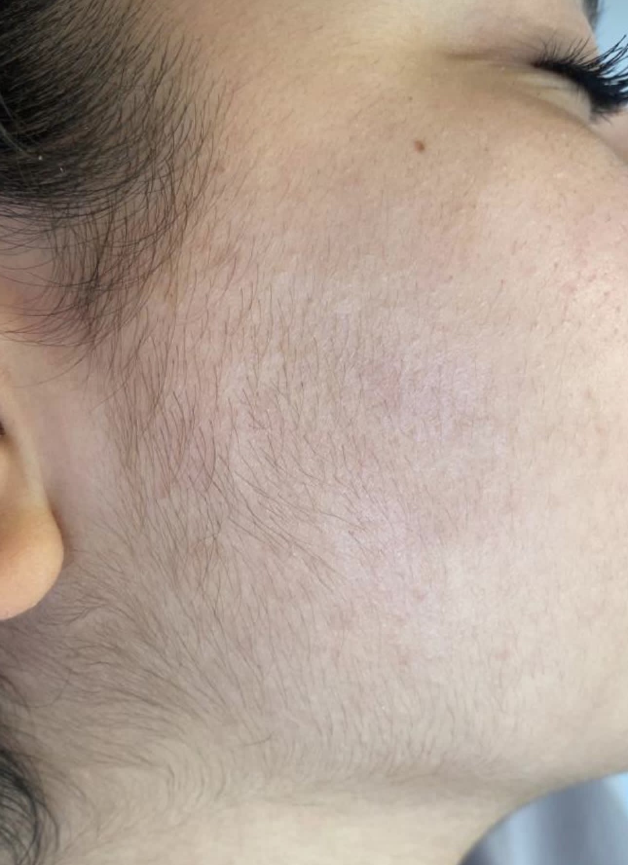 T-Element Neo treatment result 1