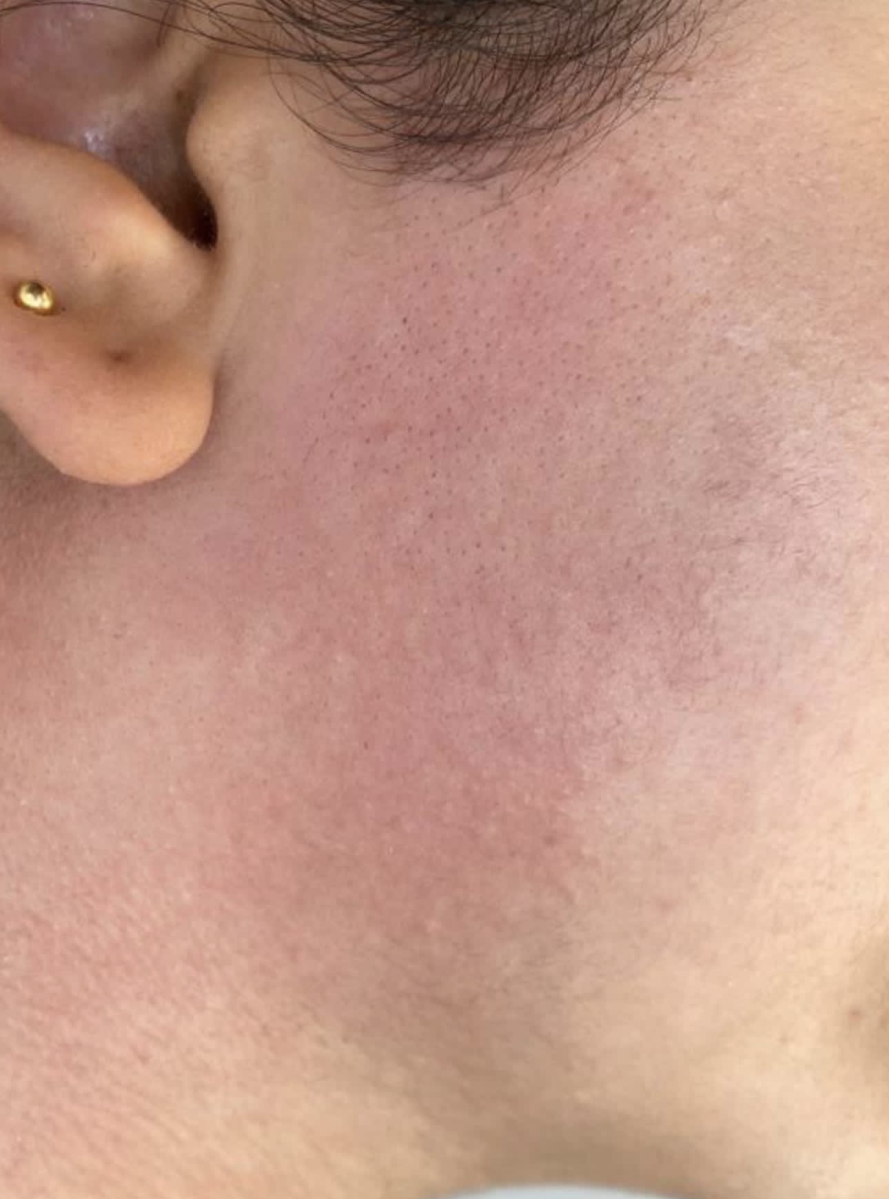 T-Element Neo treatment result 2