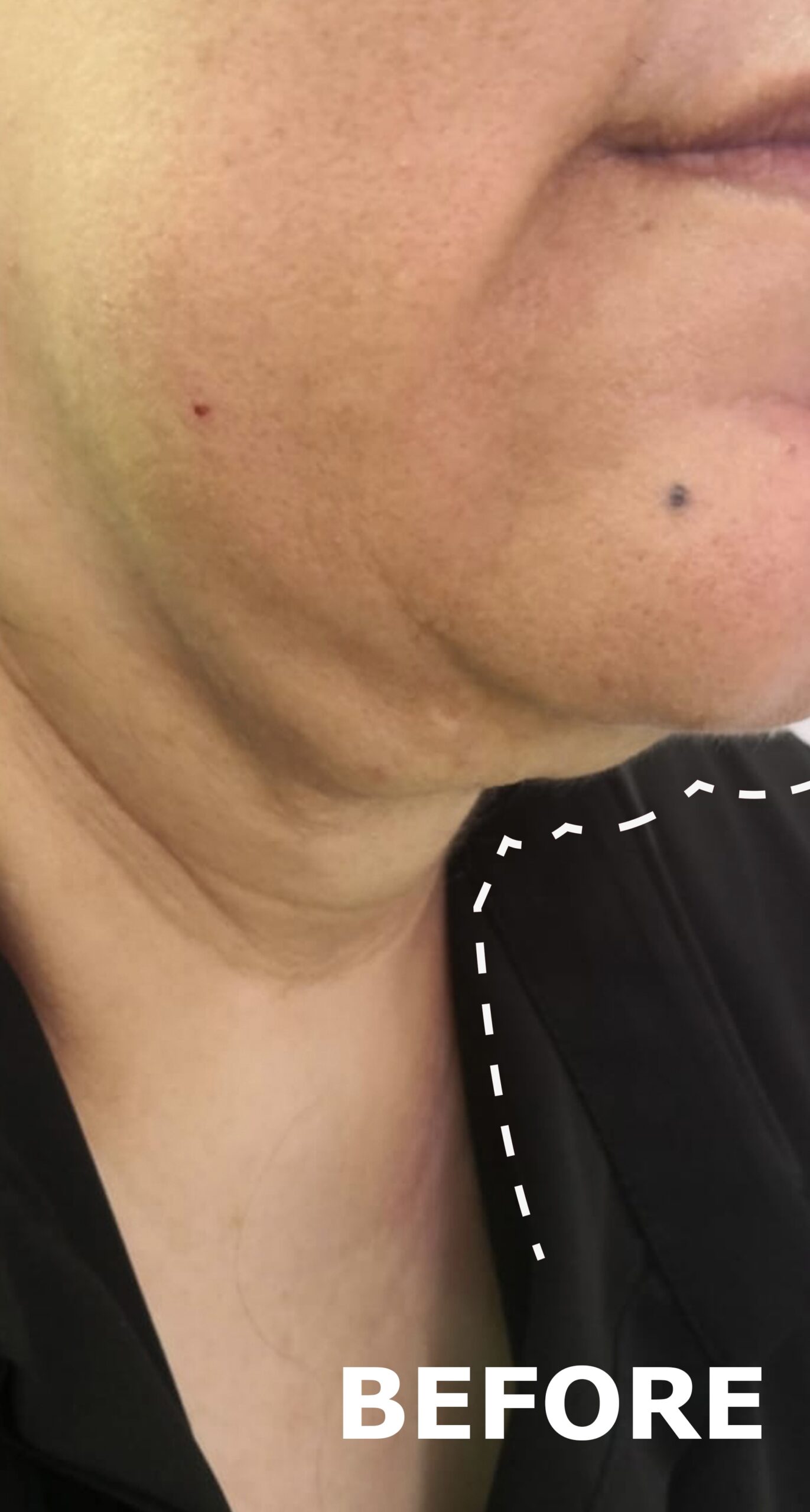 Triumph Neo treatment result 3