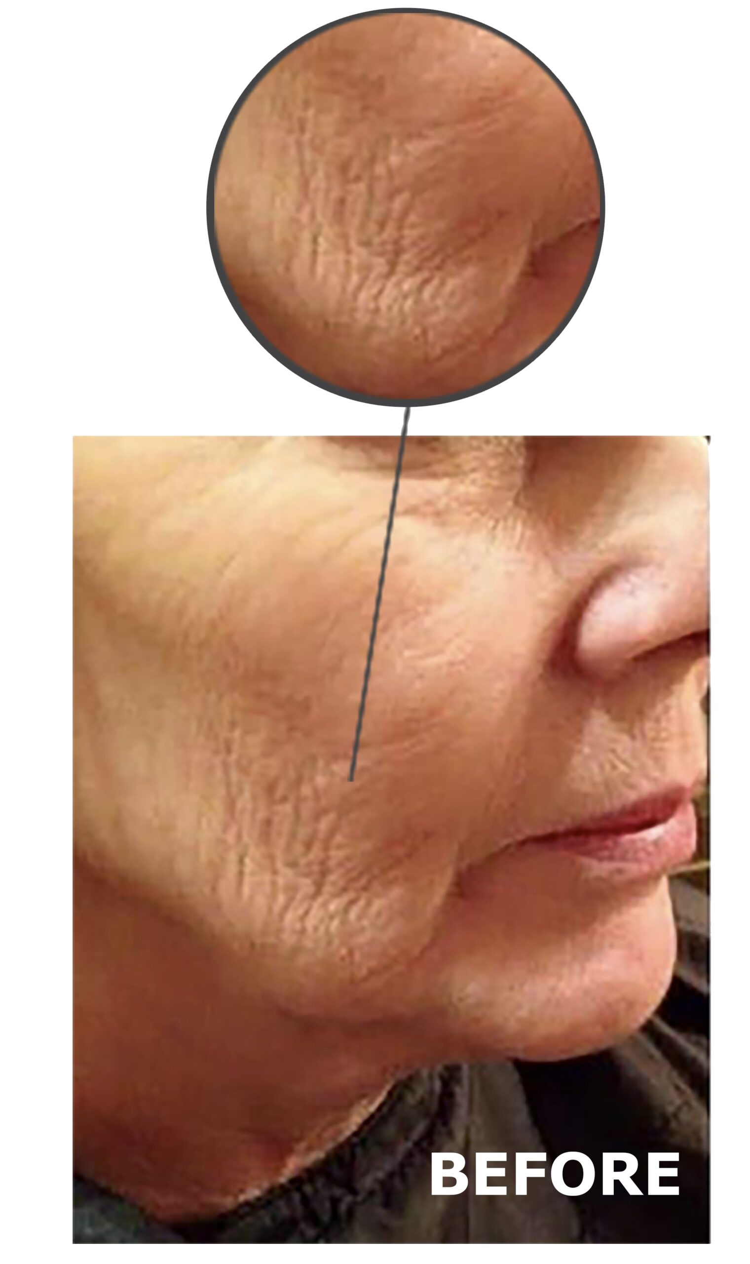 Triumph Neo treatment result 1