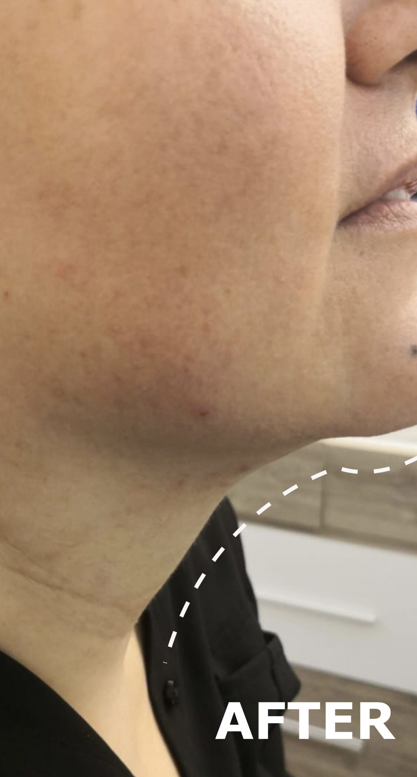 Triumph Neo treatment result 4