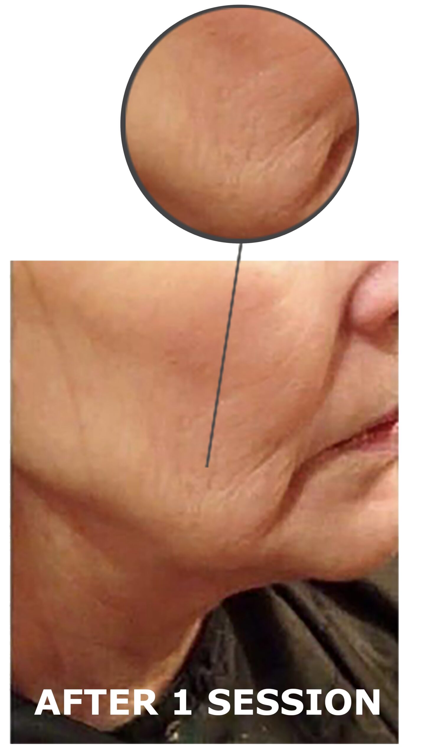 Triumph Neo treatment result 2