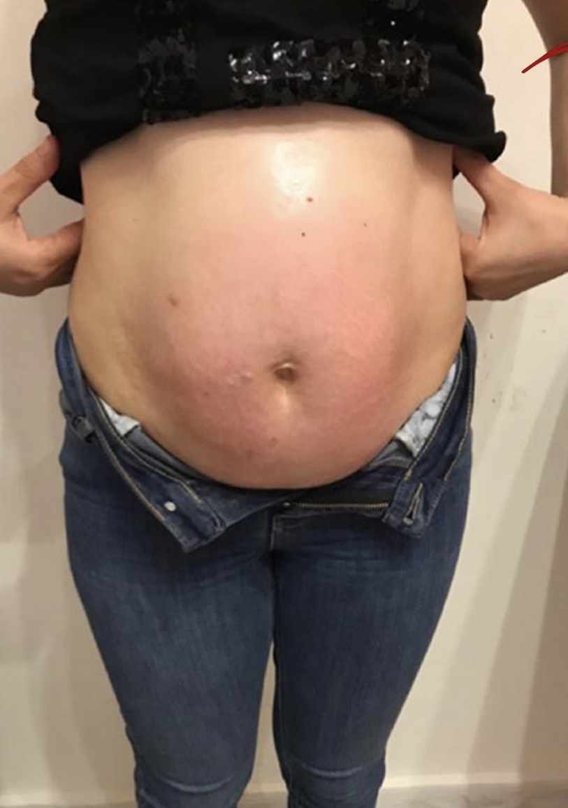 Contoura treatment result 1