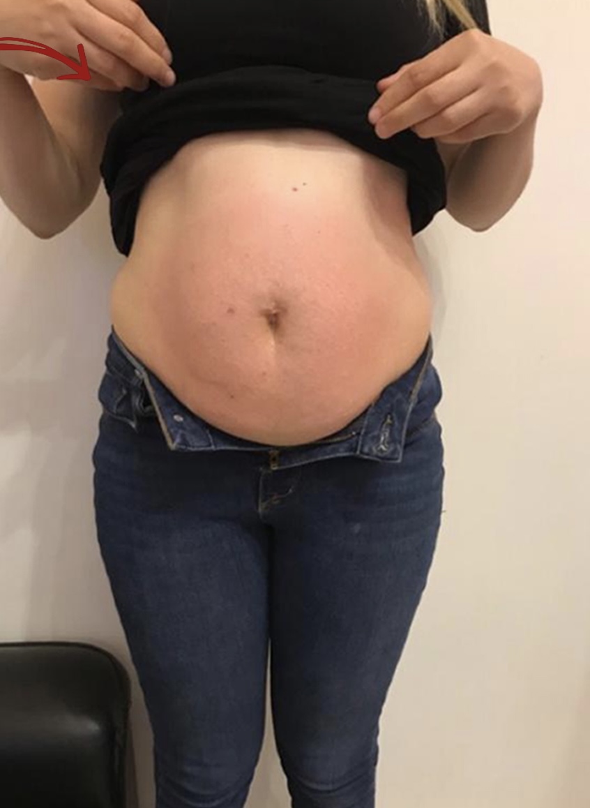 Contoura treatment result 2