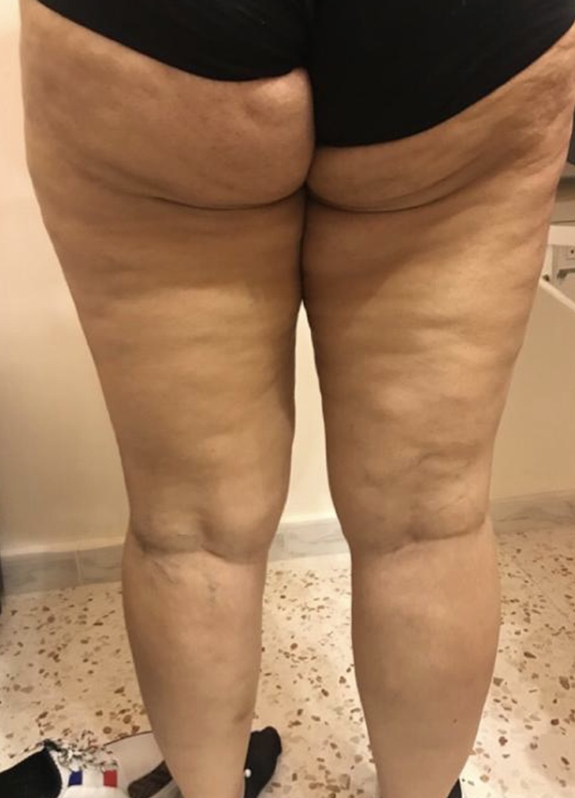 Contoura treatment result 3