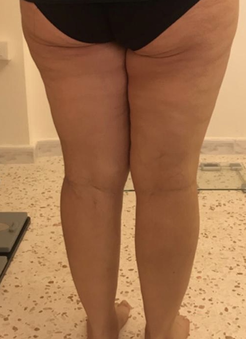 Contoura treatment result 4