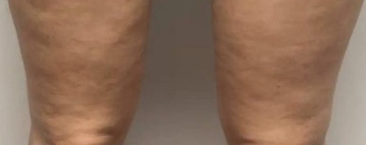Cratus Plus treatment result 1