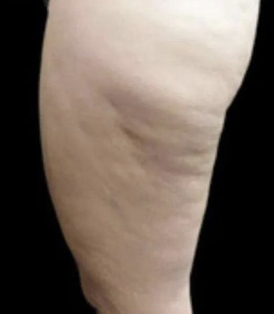 Cratus Plus treatment result 2