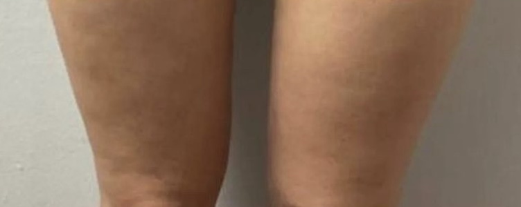 Cratus Plus treatment result 3